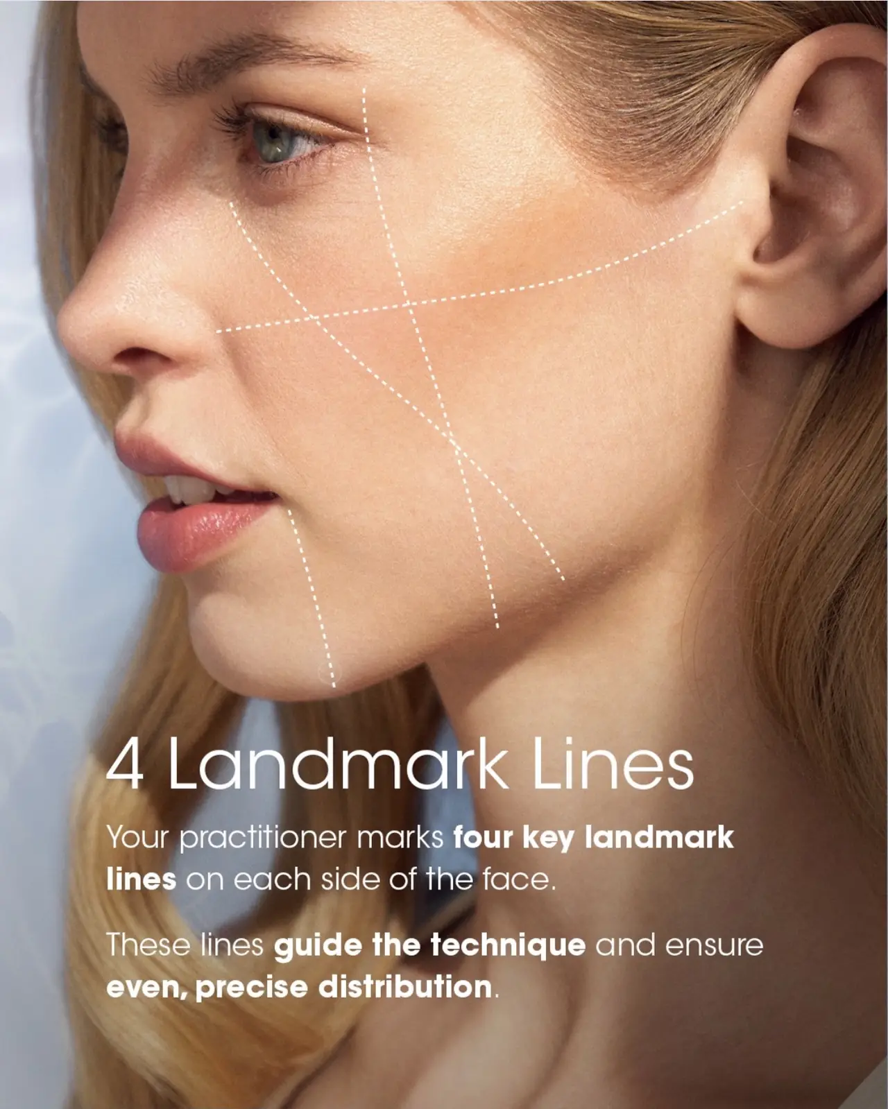 Teoxane babyGLOW injection technique — 4 landmark lines and 8 injection points per side, South Woodford London